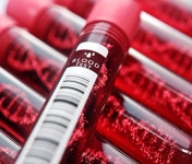 [특징주] 아이엠비디엑스, 아스트라제네카와 추가 계약 논의 소식에 급등