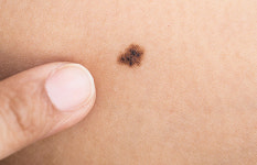 팔에 점이 11개 이상이면? 집에서 하는 초간단 건강검진