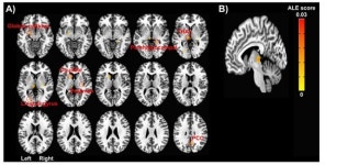 만성 통증 치료 후 뇌 부위 기능적 활성↓ 대사 활성 증가↑