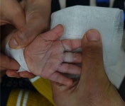 [기고] 가열식 가습기에 접촉에 의한 손가락 짐재성 2도 화상 치료 경과과정