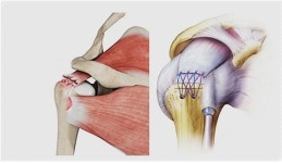 대전 세우리병원 유재응 원장, 회전근개 파열