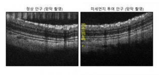 비엔텍 중앙연구원 “미세먼지=안과 질환 원인, 과학적 입증”… 신약 개발 본격화