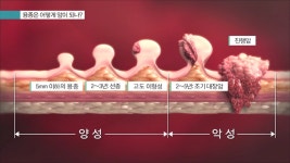 '명의' 대장의 혹, 암일까?