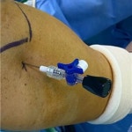 천안.아산충무병원 정형외과 유재성 박사 절개 없는 초소형 내시경 치료 도입