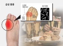 바람만 스쳐도 아픈 통풍… 치맥·곱창 피하라
