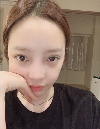 구하라 '안검하수' 완치 수순…