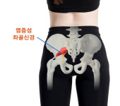 [의료칼럼] 허리 통증, 모두 디스크? 같은 증상 다른 질환 이상근 증후군