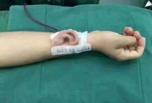 오른팔에서 인공 귀가 자라는 남성