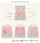 소화관 전체에 발생하는 만성 염증성 질환 '크론병'…주로 일어나는 증상은?