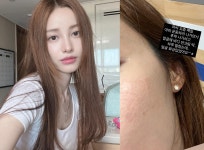 "야외 운동 위험성?"…유깻잎, 얼굴 화상 고백
