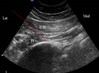 [의료] 허리디스크가 아니라고? 이상근증후군과 허리디스크의 차이점