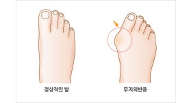 [메디컬금강]신발 벗기 창피한 무지외반증