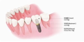 오스템임플란트, 디지털 덴티스트리 앞세워 글로벌 1위 도약