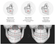  안면비대칭교정, 나는 보험적용이 될까 안될까 