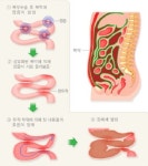 마왕 신해철을 빼앗아간 장유착이란 무엇인가?