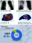 비흡연 여성 폐암 증가…술집서 2시간, 담배 4개비 직접흡연 효과