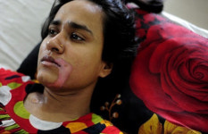 시댁 식구에게 염산 테러 당한 女…이유가?