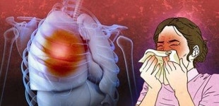 부산의료원서 집단 잠복결핵 양성 판정