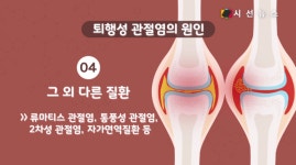 [건강프라임] 나이든 여성에게 더 위험한 퇴행성 관절염 / 김병용 기자