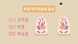 [건강프라임] 코막힘 심하다면 이것 의심해 봐야 / 김태웅 기자