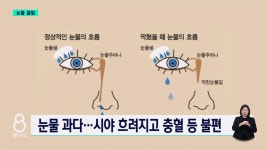 [닥터리포트]25팔 눈물 흘림 동산 안과 이동철