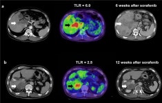 진행성 간암, PET/CT 검사로 치료 결과 예측 가능