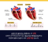 심방세동 환자 위한 항응고제, 제대로 알고 드세요