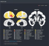 인포메디텍, 치매예측 ‘뉴로아이’ 태국 병원 계약