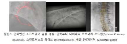 인터벤션시술서워크플로우극대화 엑스레이,아주리온3·아주리온5