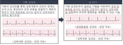 진단 어려운 발작성 심방세동, 딥러닝 이용해 예측한다