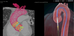 미 TAVI-TAVR AI 소프트웨어 승인