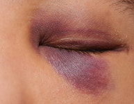 “아직도 달걀로 멍 뺀다? 레이저로 멍 치료하세요”