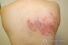 무더위로 면역력 저하, ‘대상포진’ 주의