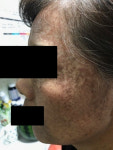 또 터진 ‘헤나 염색약’ 부작용 의혹…“뿌리염색 후 피부 계속 검어져”