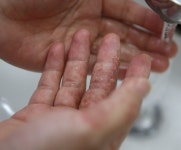 남성도 주부습진에 노출…손 잘 말리고 보습제 넉넉히 발라야