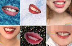 1020세대 치아 꾸미는 투스젬 열풍...치아 손상 주의해야