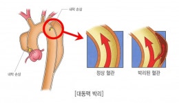 초응급 대동맥 박리, 20년 새 수술 성공률 98%
