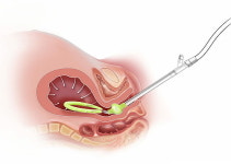 한국오가논 제이다 시스템 신의료기술 인정