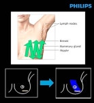 필립스 유방 초음파 검사 솔루션 ‘AI Breast’