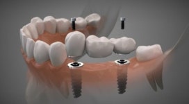 저소득층 노인 구강 건강 회복 돕는다