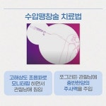 어깨오십견, 증상 초기 빠른 치료 중요