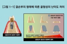 임플란트 뼈이식, 결손부의 형태에 따라 골형성 난이도 달라진다