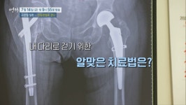 [EBS 명의] 다시 걸을 수 있을까? 고관절 통증, 인공관절 치료법