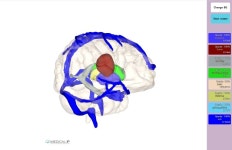 메디컬아이피, 3D프린팅한 뇌종양 모델 임상 효과에 대한 검증 받아