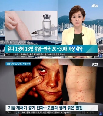 부산, 홍역 환자 발생…약 한달간 베트남에서 체류 