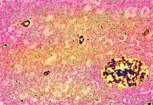 뇌 플라크 줄이고, 인지능력 감소 지연…알츠하이머 신약 확기적 효과