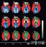빅데이터 활용해 뇌경색 더 정확하게 진단·치료