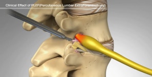 추간공확장술, 척추질환 핵심 병소 추간공 공략으로 치료 진행 [박경우 병원장 칼럼]
