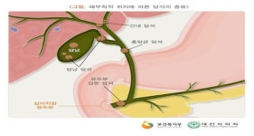 [건강만담]식사 후 상복부 뻐근하고 소화불량 '담석증' 원인 및 예방과 치료