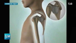 [리포트] 어깨 빠졌을 때 첫 조치가 중요